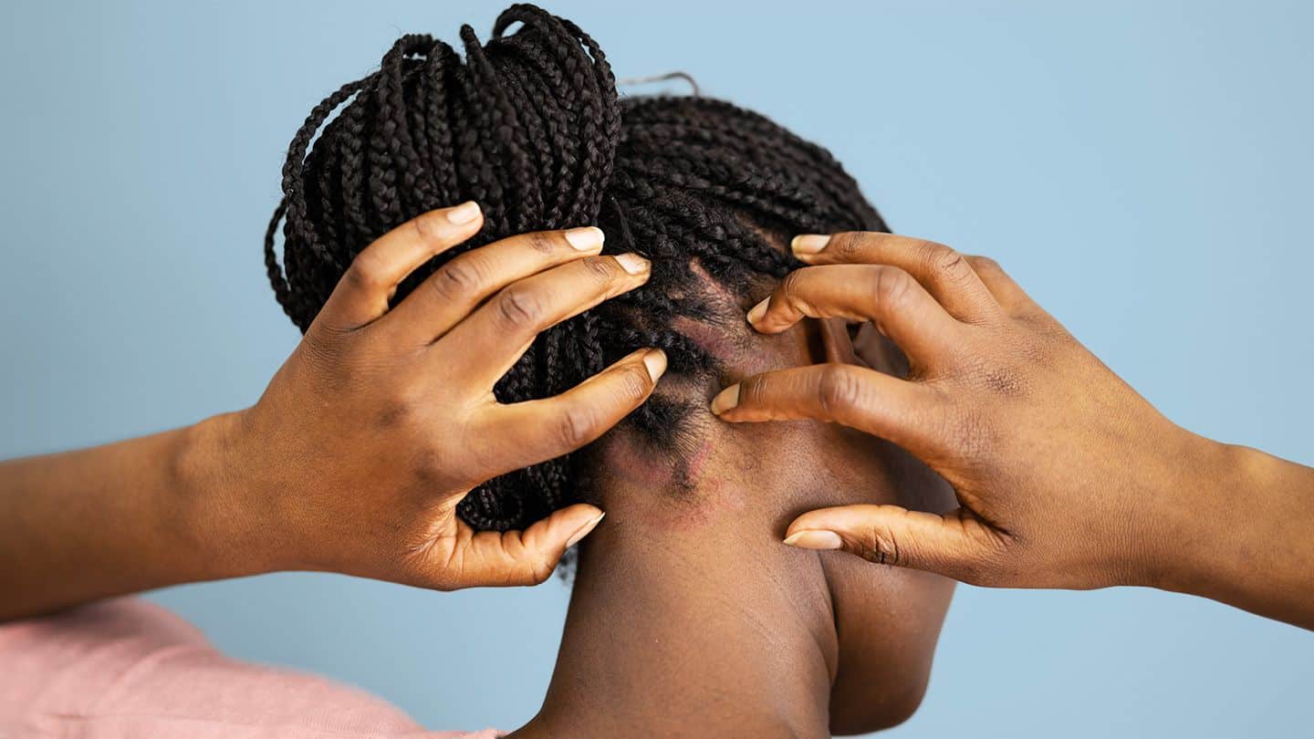 cs-psoriasis-and-black-americans-skin-alt-1440x810