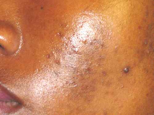 taches-noires-acne